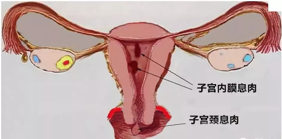 最肉的赘_得了胆结石必须切掉胆囊吗 关于胆囊切除,这些 实情 你需要知