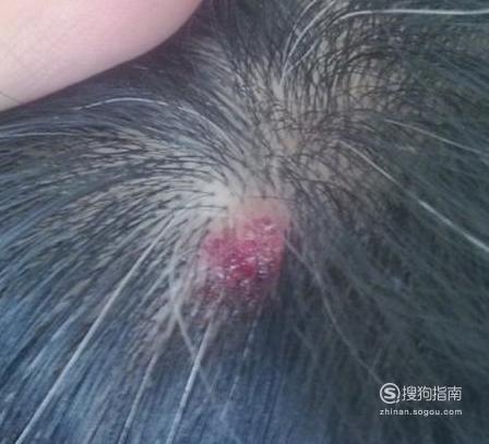 头皮毛囊炎怎么治疗用什么药