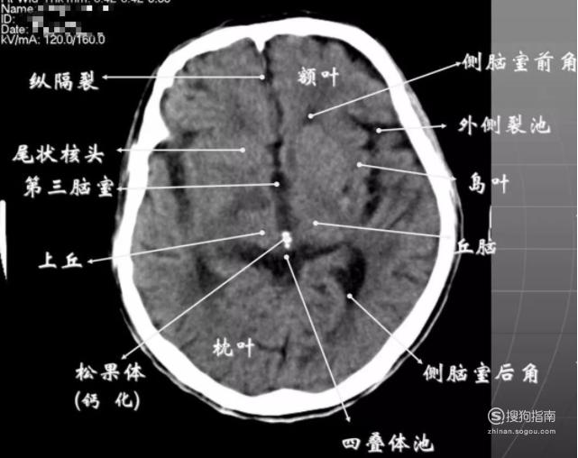 08第三脑室上部层面① 基底核,丘脑.