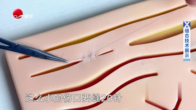 疤痕干预的黄金时间