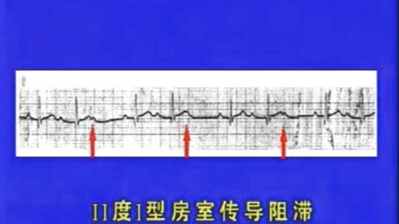 [图]心电图诊断