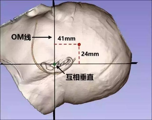 脑出血微创3d下定位七法