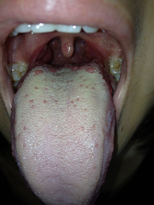 舌头根部和舌头两侧长东西,舌头根部有好多个跟黄豆一