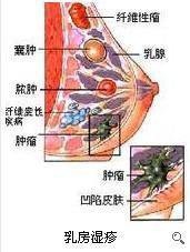 乳房乳头湿疹症状有哪些最佳治疗方法图文