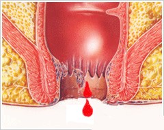 怎样知道自己得了痔疮