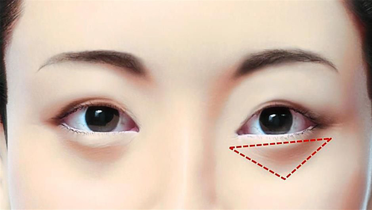 眼角细纹是什么样的?该如何去除?