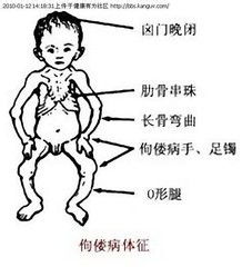 婴儿佝偻病早期症状