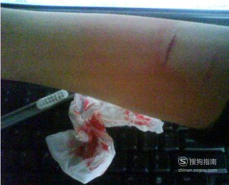 被刀割伤之后应该怎么处理 看完你就知道了 - 天晴经验网