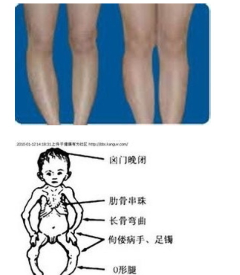 婴儿佝偻病早期症状