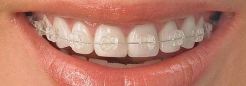 单晶透明托槽,俗称半隐形矫正,所使用的托槽近乎透明,粘在牙齿上隐蔽