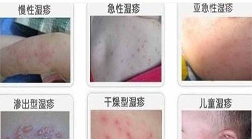 脚上长湿疹怎么办 这些经验不可多得