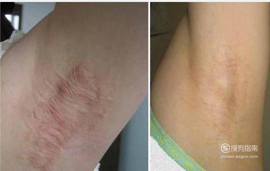 去除疤痕价格看完就知道