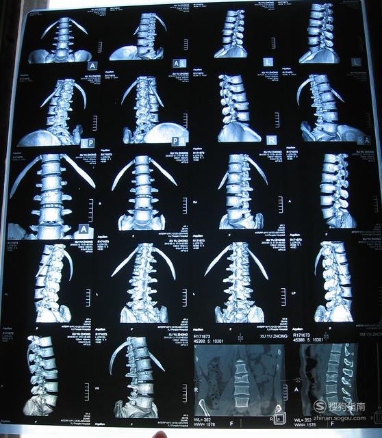 怎样依据ct片看信息来看看吧