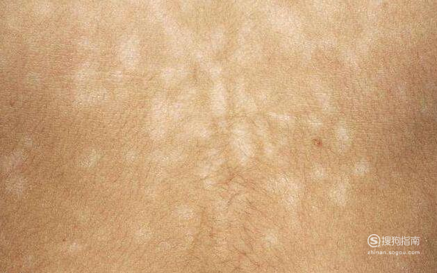 01前期白斑的外形主要为淡红色或乳红色为主,与失常皮肤之间没有明显