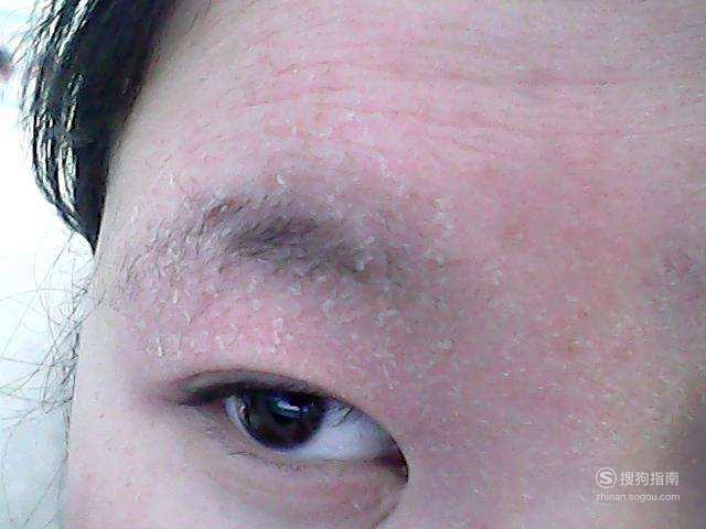 脸上起皮怎么办好今天又博学了