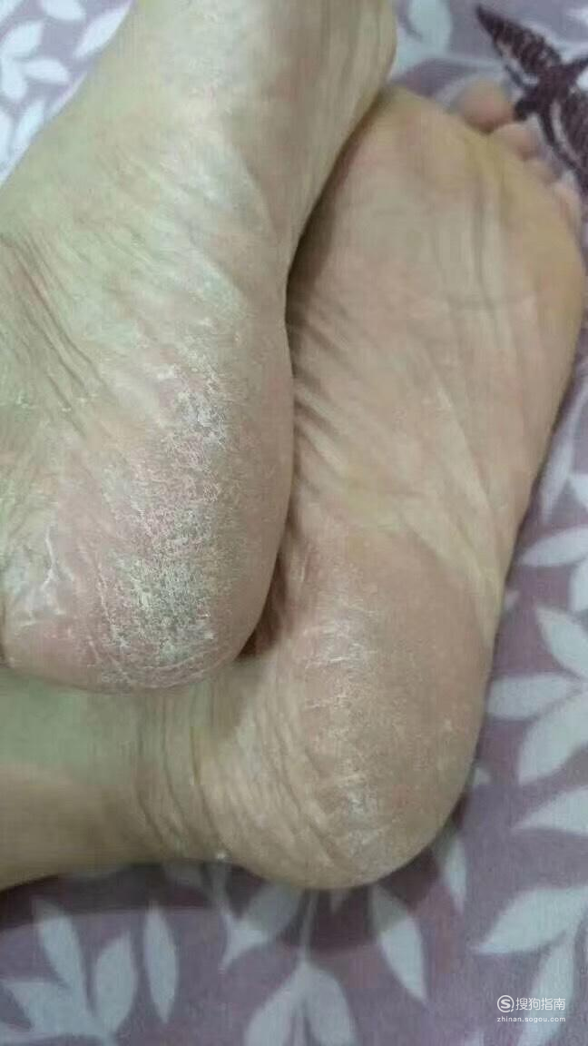 脚底脱皮怎么办学到了学到了