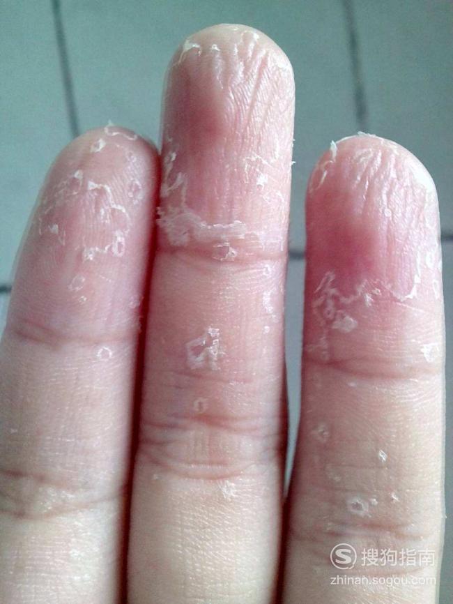 儿童手指皮肤角质化图片