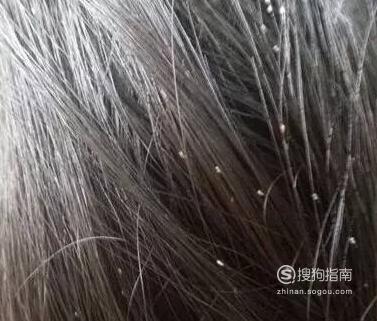 头发长虱子的处理方法头发上有虱子该怎么治4.8万阅读 头发长虱子的处理方法