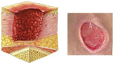 褥疮的分期方法