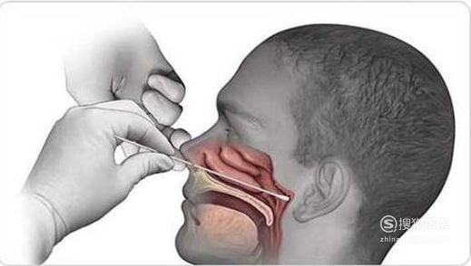 鼻咽拭子样本采集方法 基因检测-一次性鼻咽拭子采样流程