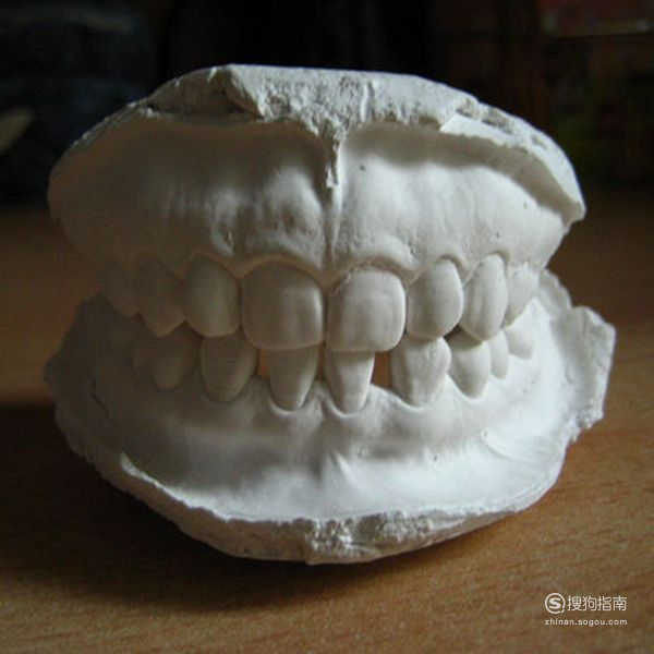 牙套矫正牙齿大概多少钱 牙齿矫正：带牙套多少钱？我的整牙价格
