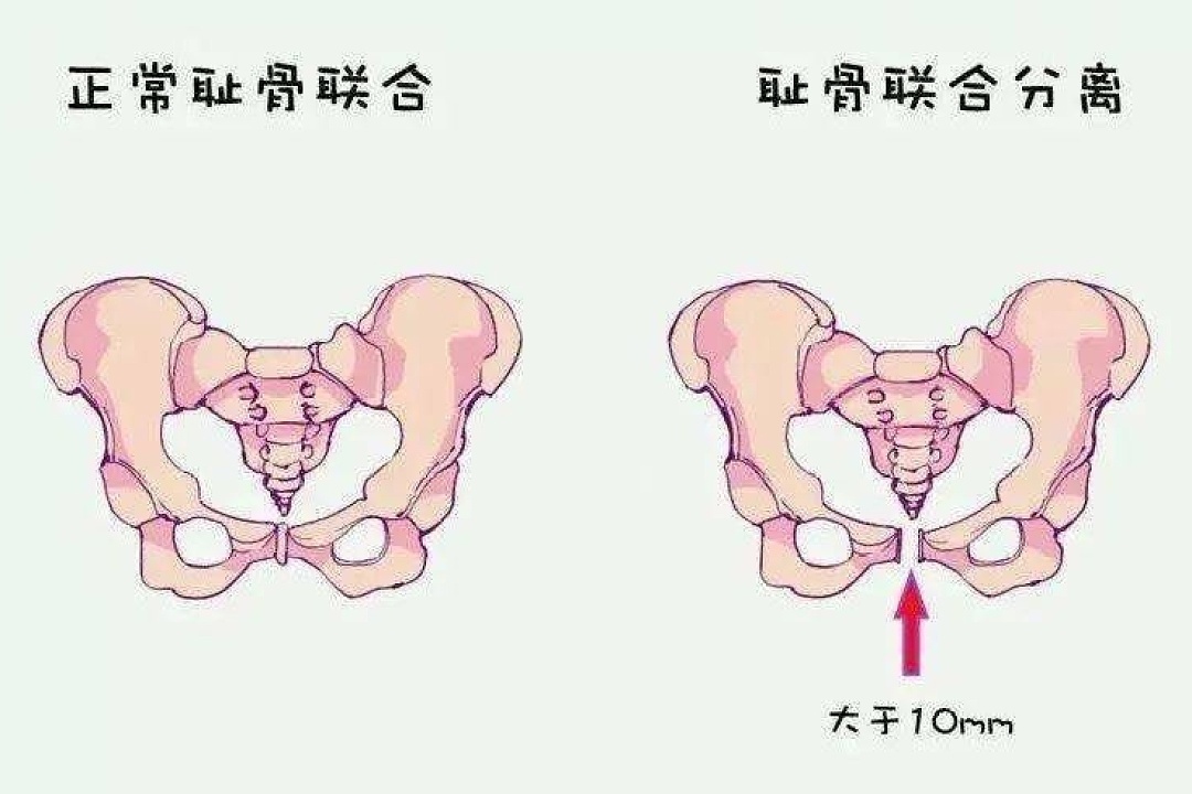 耻骨 髋骨的前下部 搜狗百科