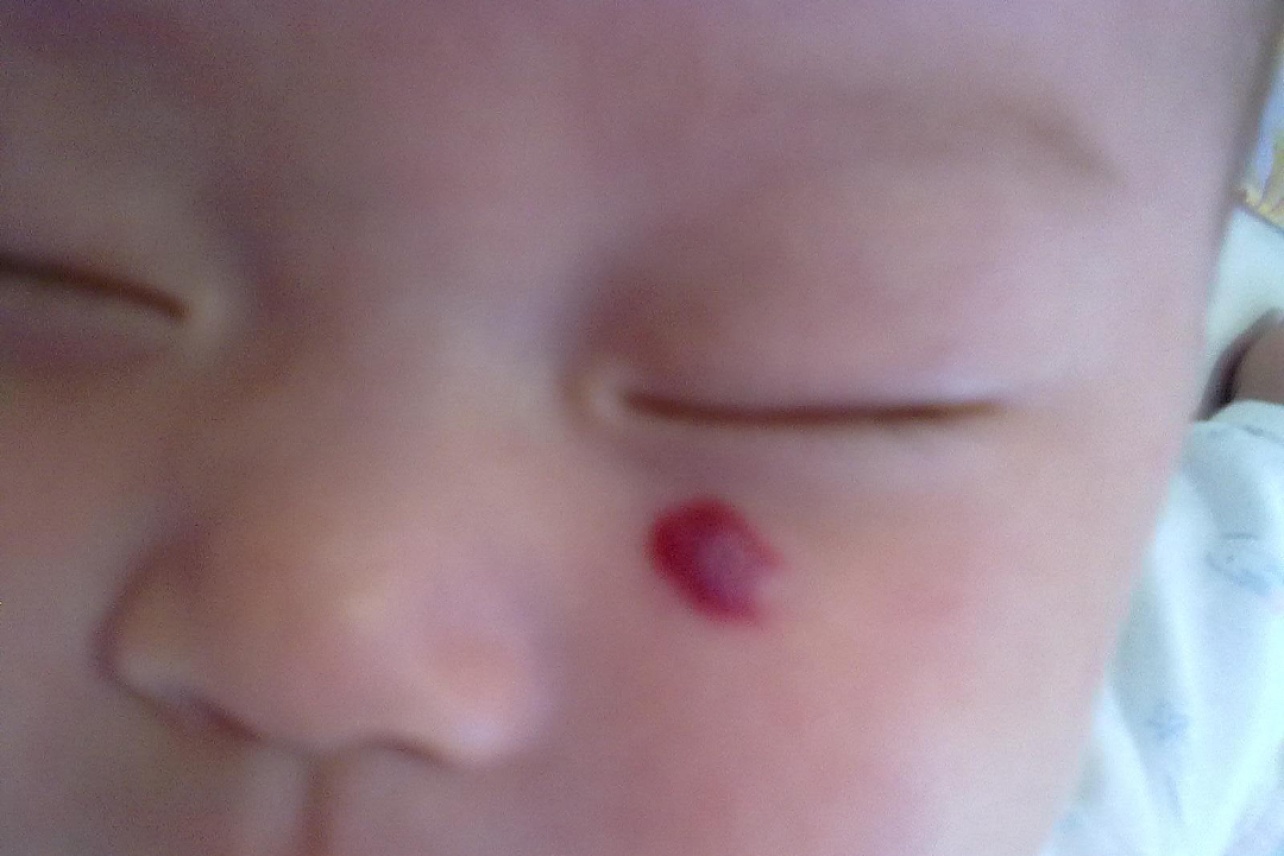 婴儿脸上有紫色点点（宝宝身上有鲜红斑痣）-幼儿百科-魔术铺