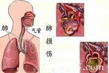 肺爆震伤 搜狗百科